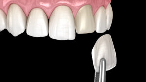 What are the types of dental veneers?