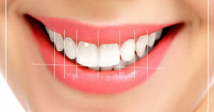 Hollywood Smile Psychological Benefits