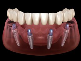 HOW IS THE STRAUMANN IMPLANT BRAND?