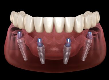 HOW IS THE STRAUMANN IMPLANT BRAND?