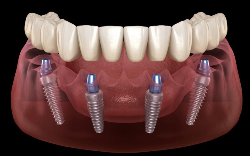 HOW IS THE STRAUMANN IMPLANT BRAND?