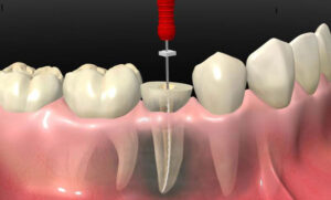 In Which Cases Is Root Canal Treatment Done?