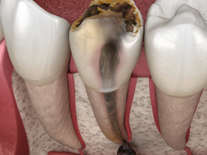 IN WHICH CASES IS ROOT CANAL TREATMENT DONE?