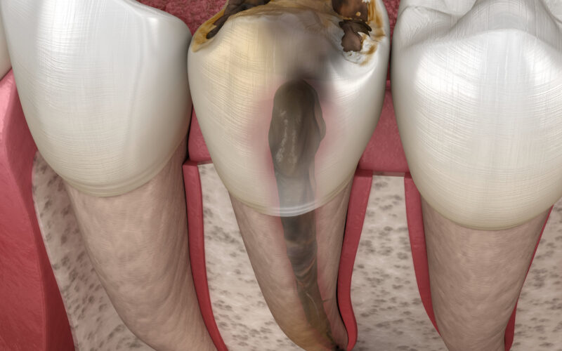 IN WHICH CASES IS ROOT CANAL TREATMENT DONE?