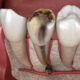 IN WHICH CASES IS ROOT CANAL TREATMENT DONE?