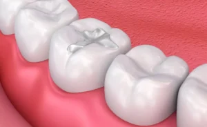 What Is The Difference Between Composite Dental Filling And Other Filling Types?