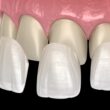 What are the types of dental veneers?