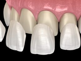 What are the types of dental veneers?