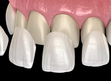 What are the types of dental veneers?