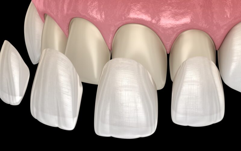 What are the types of dental veneers?