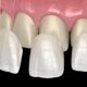 What are the types of dental veneers?