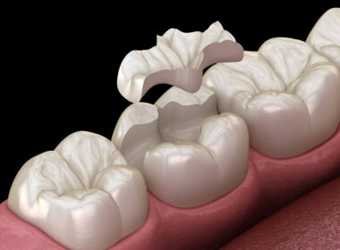 WHAT IS THE DIFFERENCE BETWEEN COMPOSITE DENTAL FILLING AND OTHER FILLING TYPES?