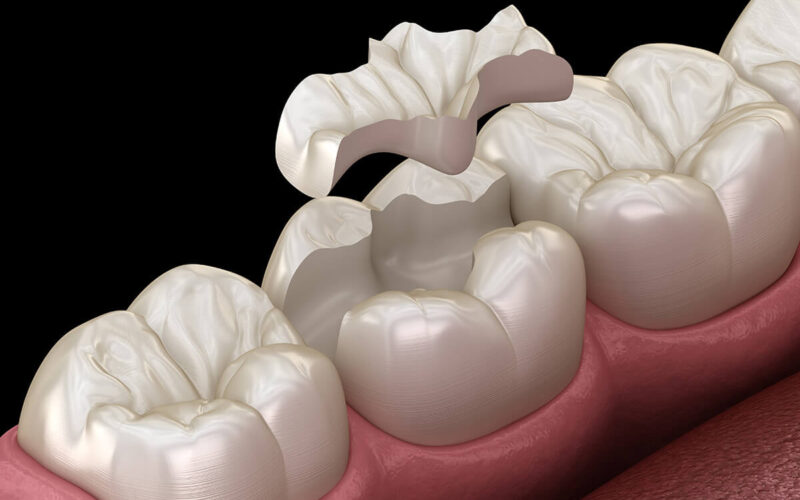 WHAT IS THE DIFFERENCE BETWEEN COMPOSITE DENTAL FILLING AND OTHER FILLING TYPES?