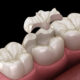 WHAT IS THE DIFFERENCE BETWEEN COMPOSITE DENTAL FILLING AND OTHER FILLING TYPES?