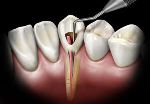 What Is The Effect Of Root Canal Treatment On General Health?