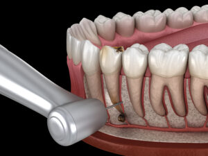 WHAT IS THE EFFECT OF ROOT CANAL TREATMENT ON GENERAL HEALTH?