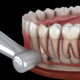 WHAT IS THE EFFECT OF ROOT CANAL TREATMENT ON GENERAL HEALTH?