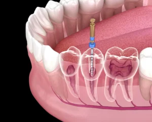 What Problems Can Be Solved With Dental Root Canal Treatment