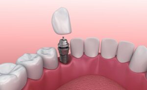 Who Is Dental Implant Used For?