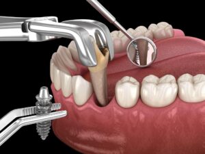 Who is Dental Implant used for?