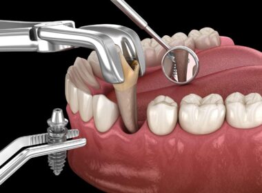 Who is Dental Implant used for?