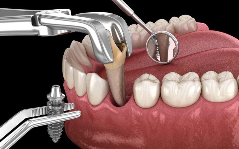 Who is Dental Implant used for?