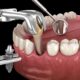 Who is Dental Implant used for?