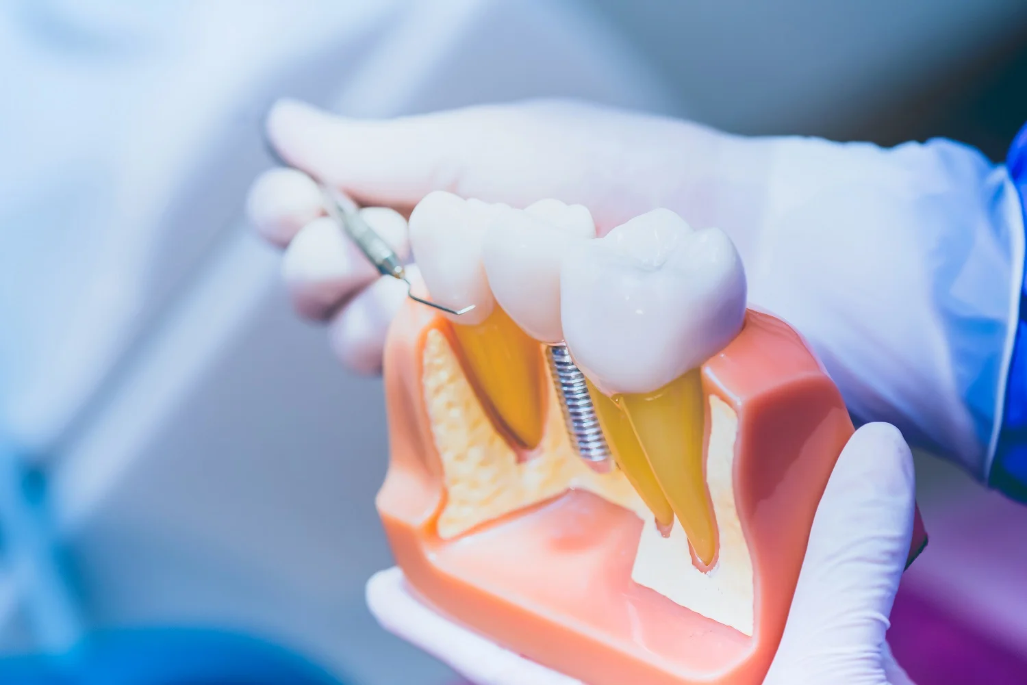 Dental İmplant Fİyatları