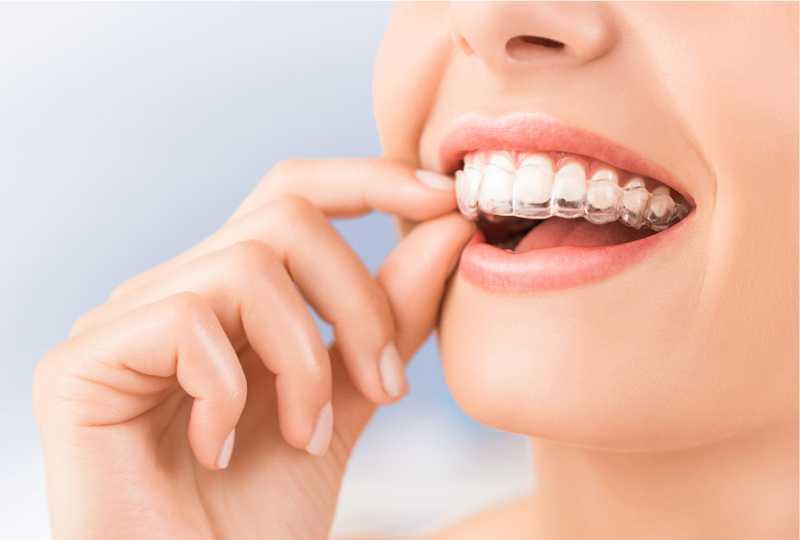 INVISALIGN