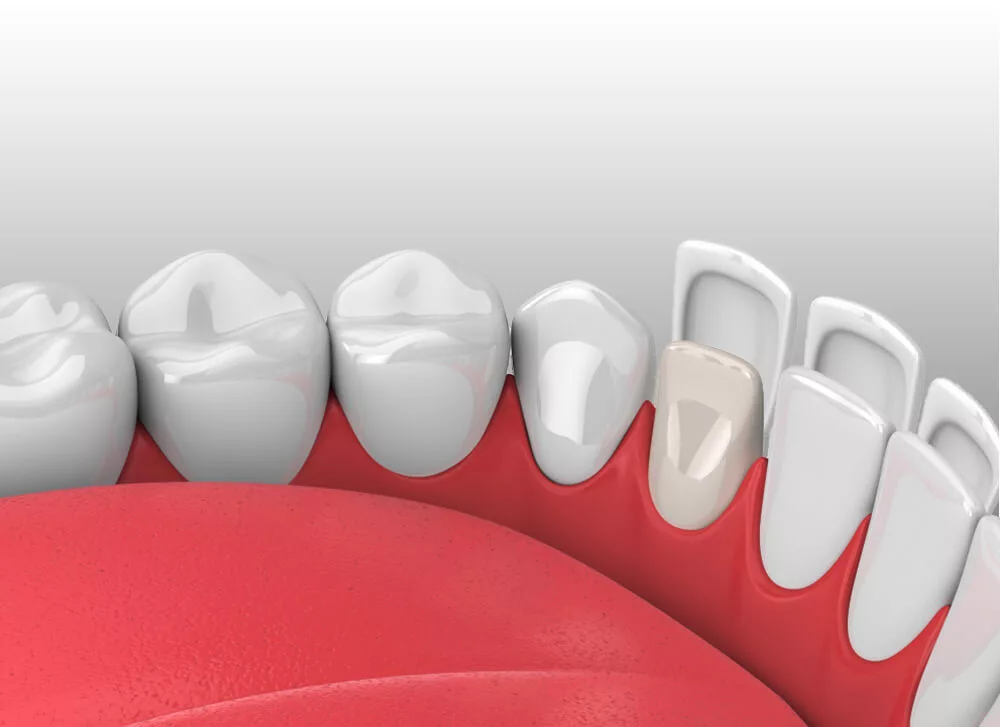 What Is Full Ceramic Empress Dental Veneer?