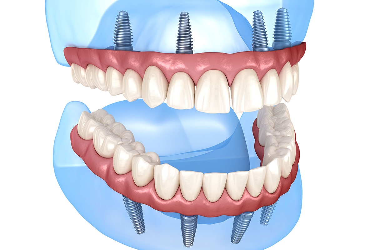 All-on-4 implant