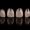 laminate-teeth
