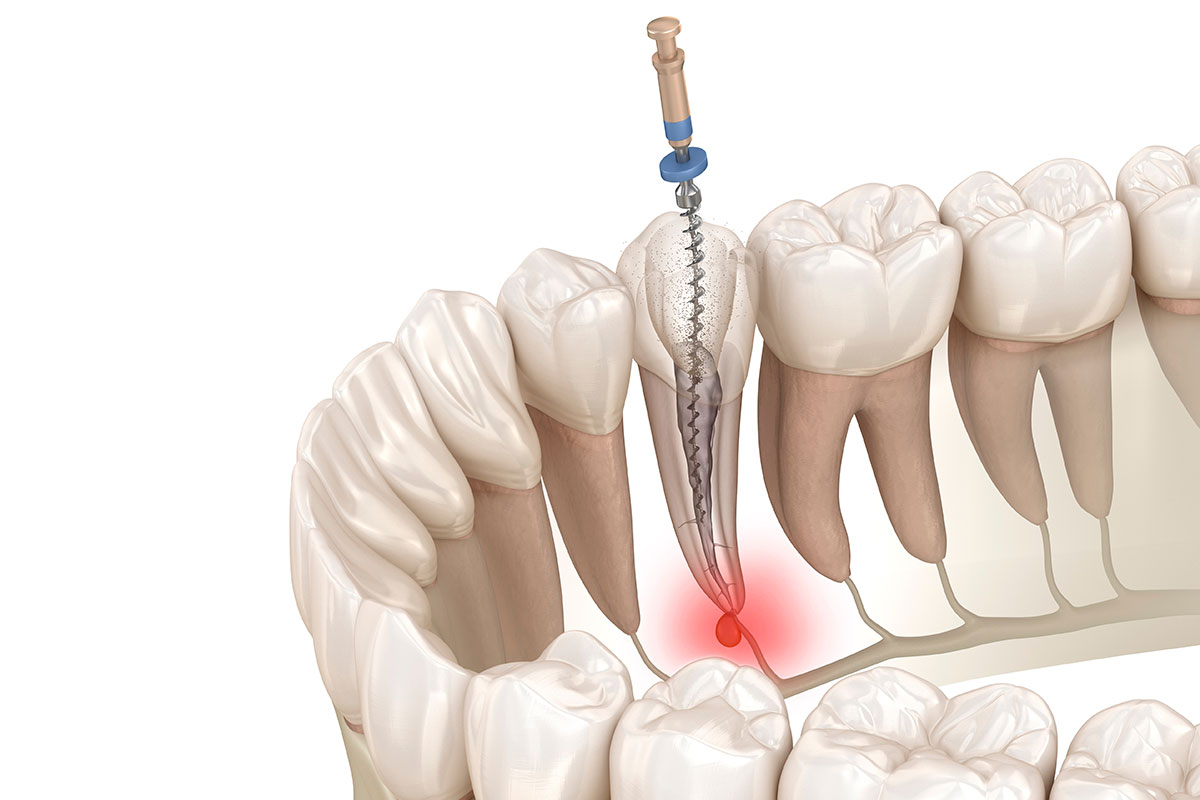 Kanal Tedavisi (Endodonti)